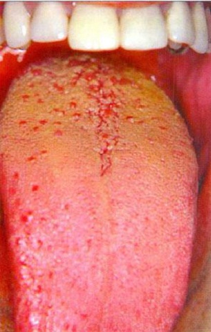 عامل اصلی التهاب لثه و ایجاد بوی بد دهان